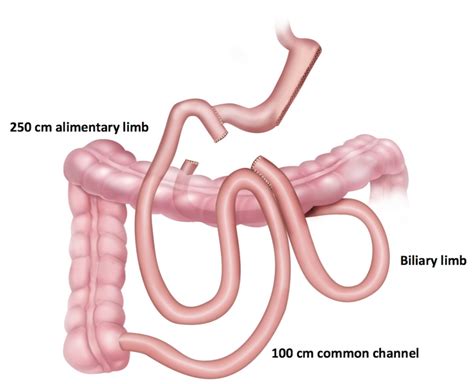 Duodenal Switch Surgery | Aloha Surgery | Weight Loss Surgery