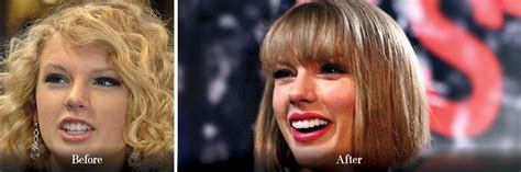 Taylor Swift New Teeth 2024 - Pepi Angelika