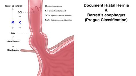 Barrett's Esophagus Prague Classification