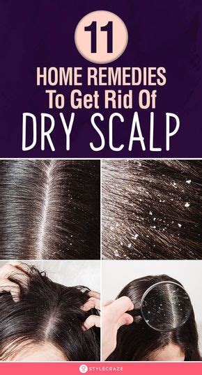 Dry scalp remedy – Artofit