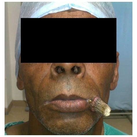 (PDF) Carcinoma Buccal Mucosa Underlying a Giant Cutaneous Horn: A Case ...