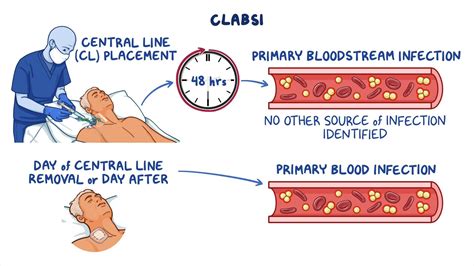 Central line-associated bloodstream infection: Clinical sciences ...