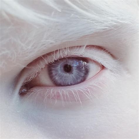 What Color Eyes Do Albino Humans Have - Etheridge Larry