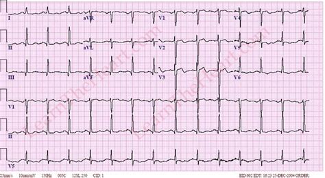 Wellen's Syndrome (Example 4) | LearntheHeart.com