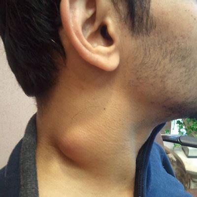 What Type Of Cancer Causes Lump In Neck - CancerWalls