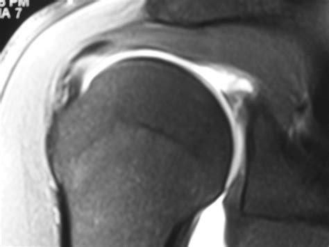 MRI of SLAP type 2 tear - Arizona Institute for Sports, Knees and Shoulders