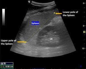 Spleen Ultrasound – How to Measure Length of the Spleen and Assess for ...