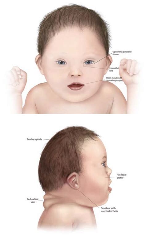 What Are Common Symptoms of Down Syndrome? - StoryMD