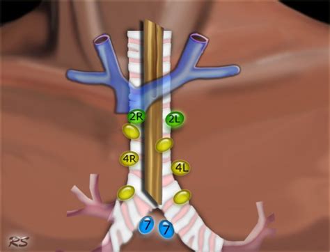 The Radiology Assistant : Mediastinal Lymph Node Map (2023)