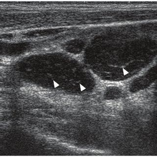 Swollen Lymph Nodes In Neck Ultrasound