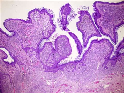 Epidermal Nevus Histology