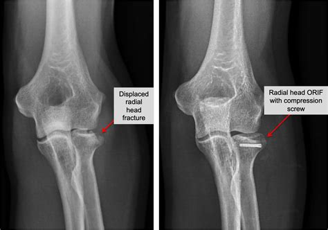 Radial Head Fracture — Joseph J. Schreiber, MD