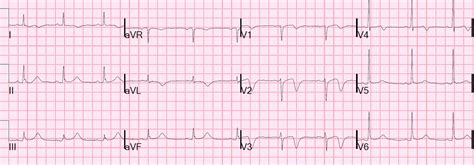 Dr. Smith's ECG Blog: Wellens' syndrome, no culprit, what happened?