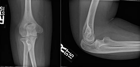 Congenital Radial Head Dislocation - Hand - Orthobullets