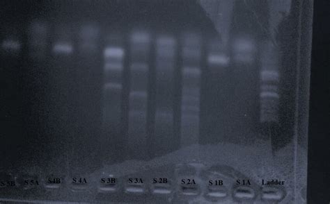 HBV DNA amplification from a plasma sample of liver cirrhosis among HBV ...