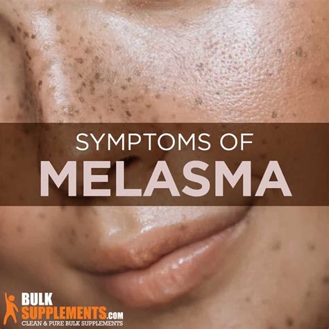 Melasma: Symptoms, Causes, Diagnosis And Treatments, 52% OFF