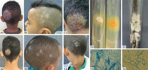 Tinea capitis scalp, causes, symptoms, diagnosis & tinea capitis treatment