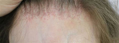 Scarring Alopecia