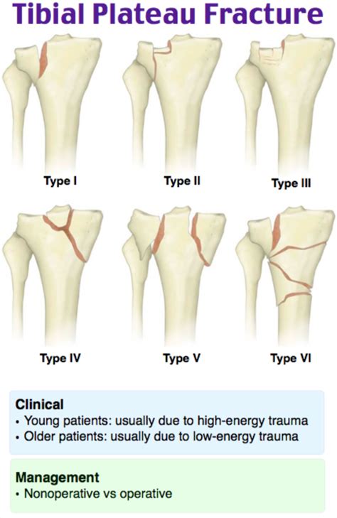 Tibial Plateau Fracture Causes Types Symptoms Diagnosis | SexiezPix Web ...