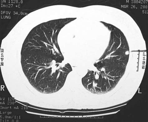 Calcified granuloma definition, causes, symptoms, diagnosis & treatment