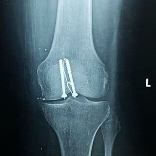 pre-operative x-rays showing simple transverse patellar fracture. In ...