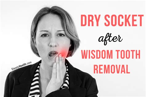 Dry Socket After Wisdom Tooth Removal | Ear, Nose, Throat, and Dental ...