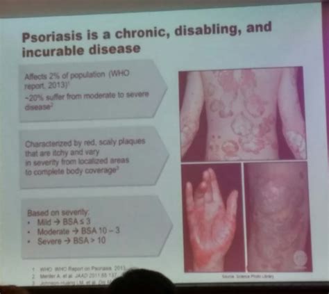 Ria Bilqis: Mengenal Psoriasis Penyakit Kulit Yang Tidak Menular