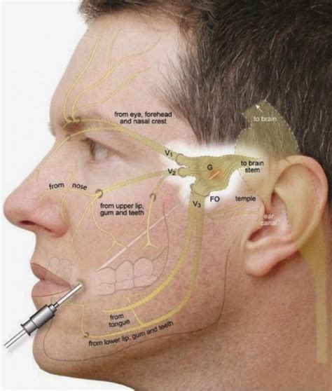 Pin on Trigeminal Neuralgia