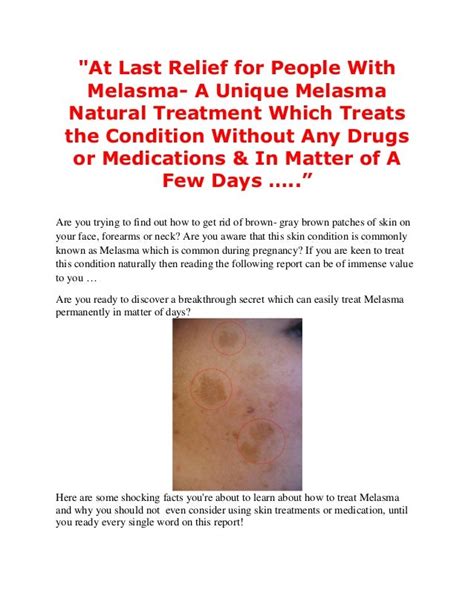 Melasma natural treatment