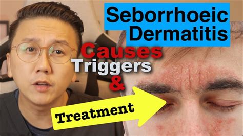 Seborrheic Dermatitis Symptoms Cause And Treatment Youtube | Hot Sex ...