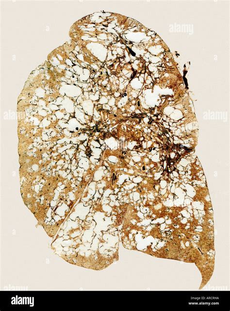 A lung section showing advanced centriacinar emphysema Stock Photo - Alamy