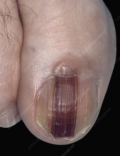 Acral Lentiginous Melanoma Finger