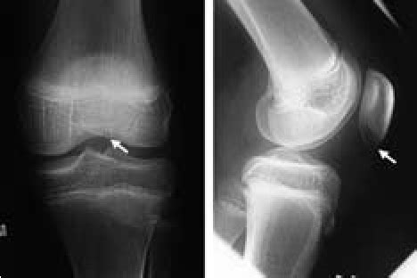 Radiographs of a minimally displaced sleeve patellar fracture; the ...