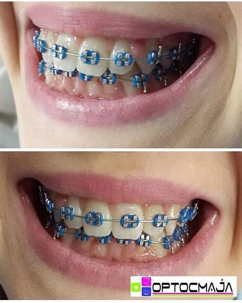 10 colored blue braces for adults and kids | Braces Explained