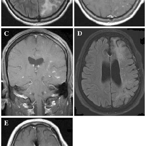 (PDF) Unilateral hemispheric primary angiitis of the central nervous system