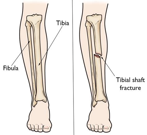 Tibia Fibula Anatomy - Anatomy Reading Source