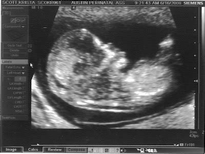 Ultrasound Nuchal Translucency