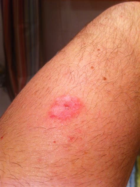 Seasonal Rash On Arms At Joseph Kinney Blog