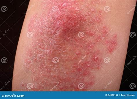 Psoriasis Stock Image Image Of Patch Dermatology Redness 84006141