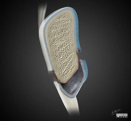 Patellar sleeve fracture | Radiology Reference Article | Radiopaedia.org