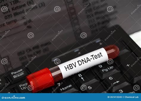 HBV DNA Test Test To Look for Abnormalities from Blood Stock Image ...