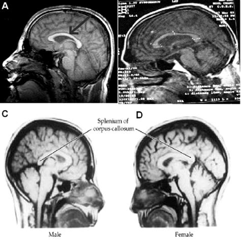 Showing position of corpus callosum in midsagittal view of MRI (arrow ...