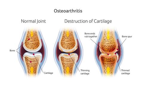 Knee problems and treatments Cartilage UPMC Sports Surgery Clinic