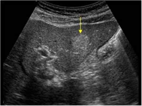 Abdomen and retroperitoneum | 1.1 Liver : Case 1.1.2 Hemangiomas ...