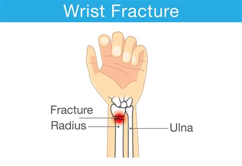 Broken Wrist: Recovery Process + Healing Tips