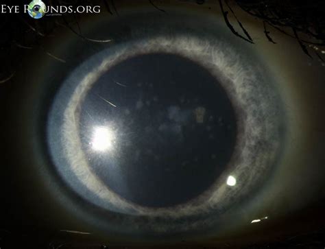 Atlas Entry - Corneal macular dystrophy