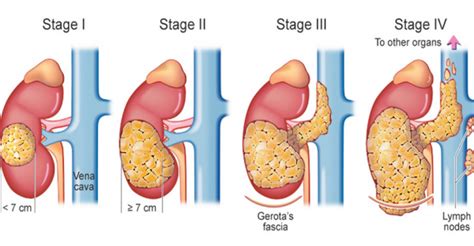 Stages of Kidney Cancer Treatment - Dr. Irfan Shaikh | Urolife Clinic, Pune