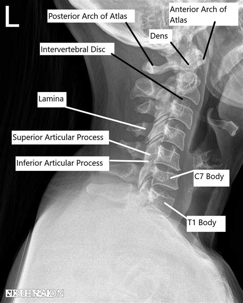 Posterior Cervical Fusion - Complete Orthopedics | Multiple NY Locations