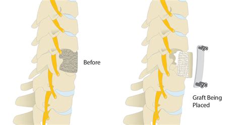 Cervical Corpectomy | Scottsdale, AZ Orthopedic Spine Surgery