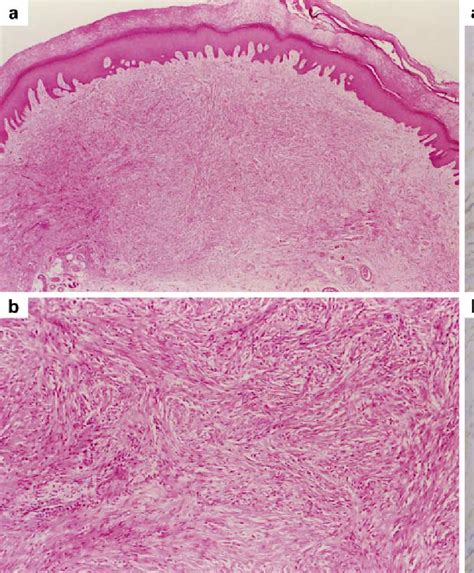 Dermatofibroma Histology